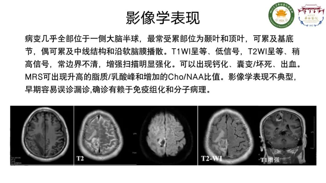 影像PPT - 【病例】弥漫性半球胶质瘤(H3G34突变型)1例MR影像-15