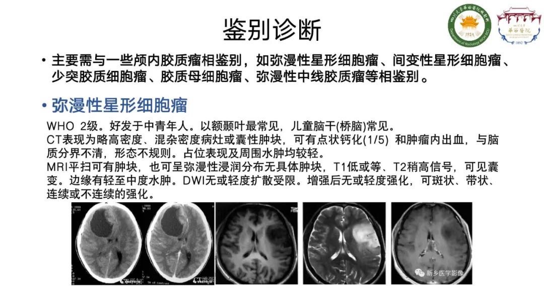 影像PPT - 【病例】弥漫性半球胶质瘤(H3G34突变型)1例MR影像-16