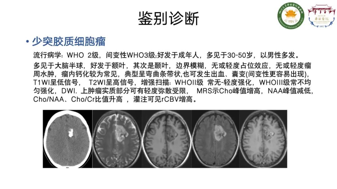 影像PPT - 【病例】弥漫性半球胶质瘤(H3G34突变型)1例MR影像-18