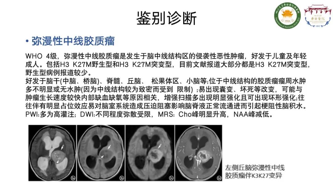 影像PPT - 【病例】弥漫性半球胶质瘤(H3G34突变型)1例MR影像-20
