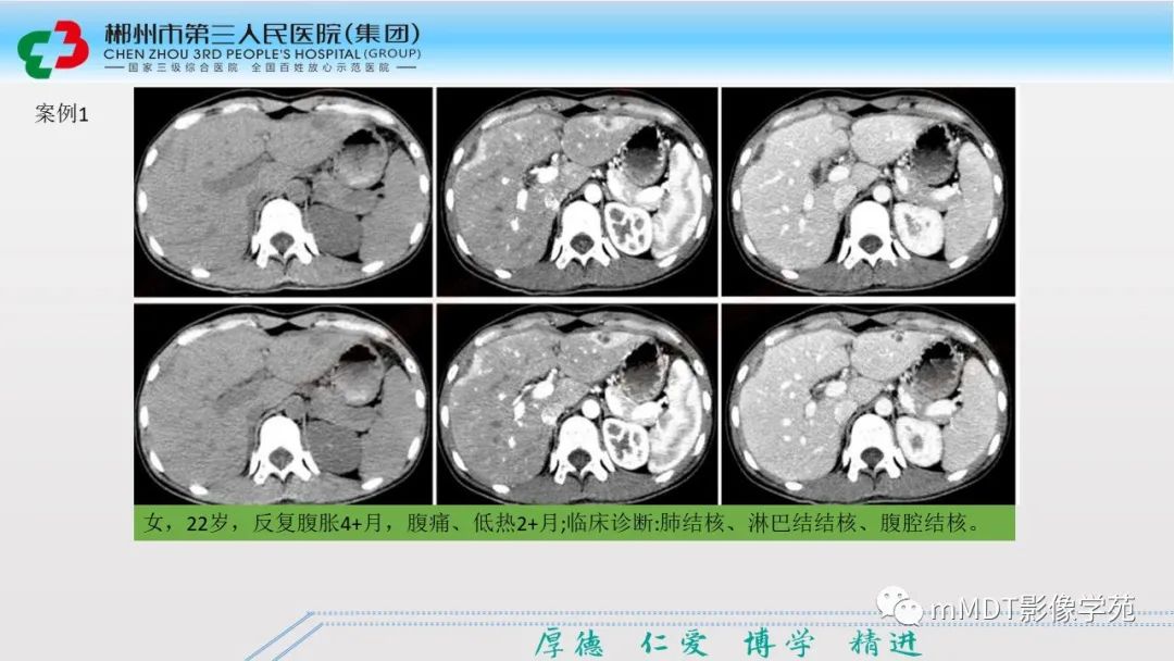 影像PPT - 【PPT】肝脏结核的CT诊断-9