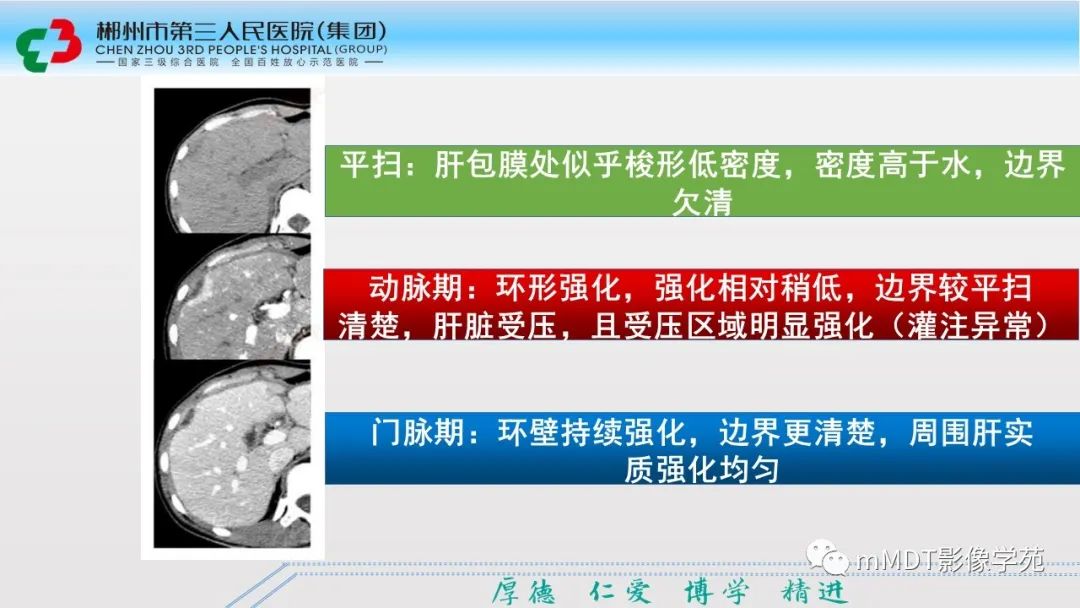 影像PPT - 【PPT】肝脏结核的CT诊断-10