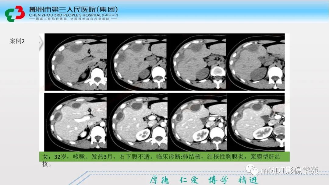 影像PPT - 【PPT】肝脏结核的CT诊断-11