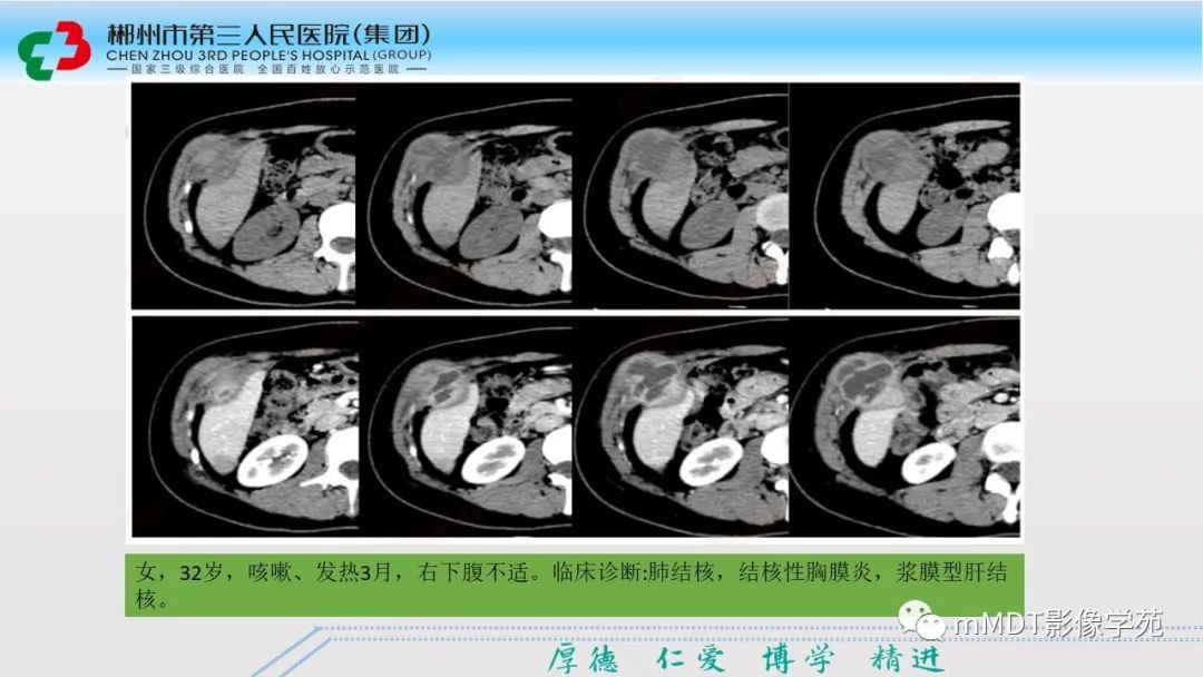 影像PPT - 【PPT】肝脏结核的CT诊断-12
