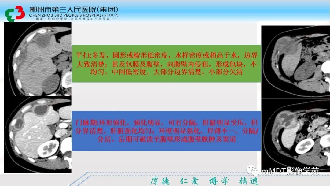 影像PPT - 【PPT】肝脏结核的CT诊断-13