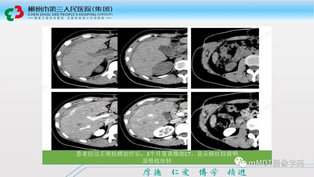 影像PPT - 【PPT】肝脏结核的CT诊断-14