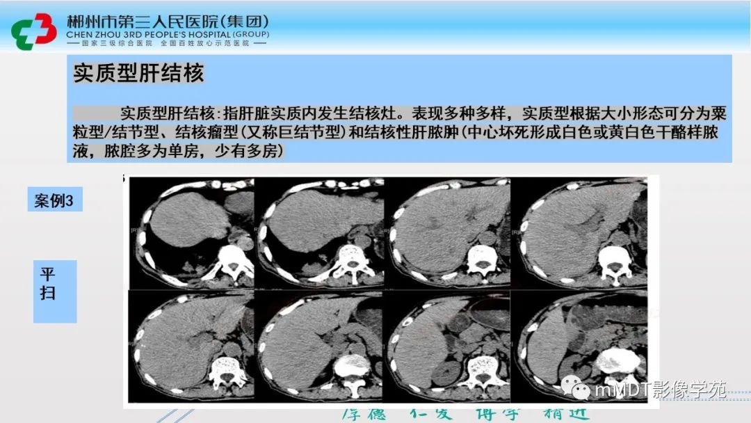 影像PPT - 【PPT】肝脏结核的CT诊断-16