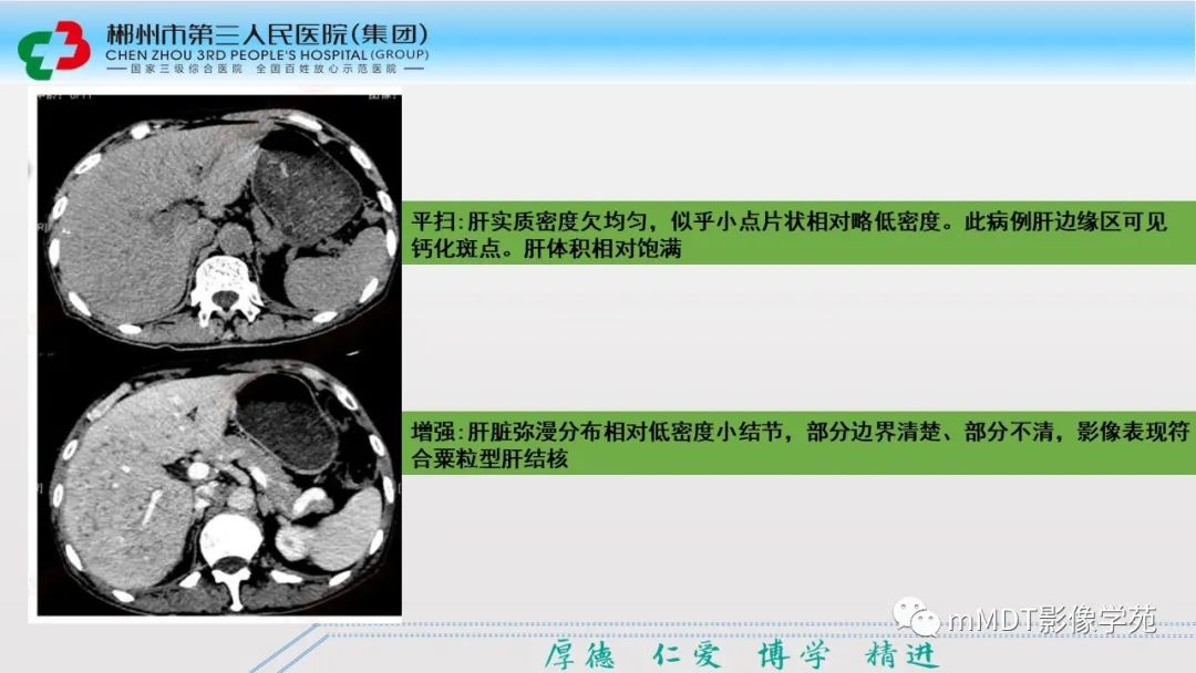 影像PPT - 【PPT】肝脏结核的CT诊断-18