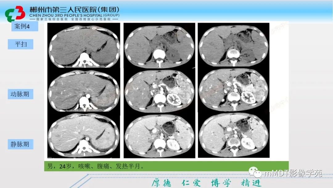 影像PPT - 【PPT】肝脏结核的CT诊断-19