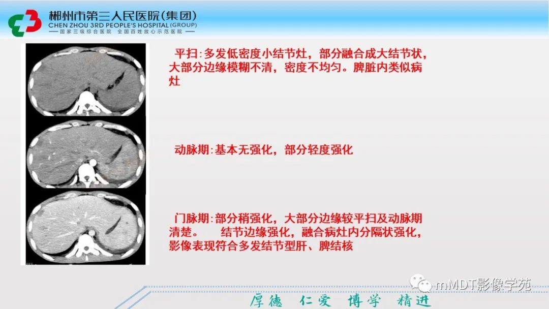 影像PPT - 【PPT】肝脏结核的CT诊断-20