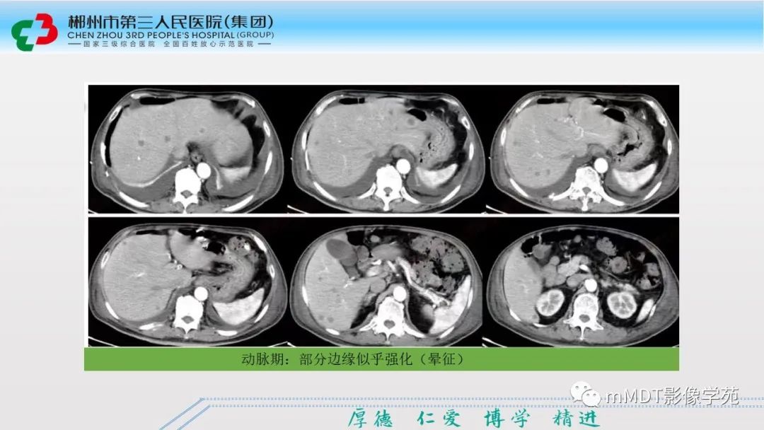 影像PPT - 【PPT】肝脏结核的CT诊断-22