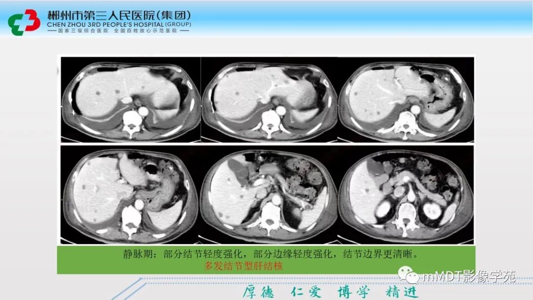 影像PPT - 【PPT】肝脏结核的CT诊断-23