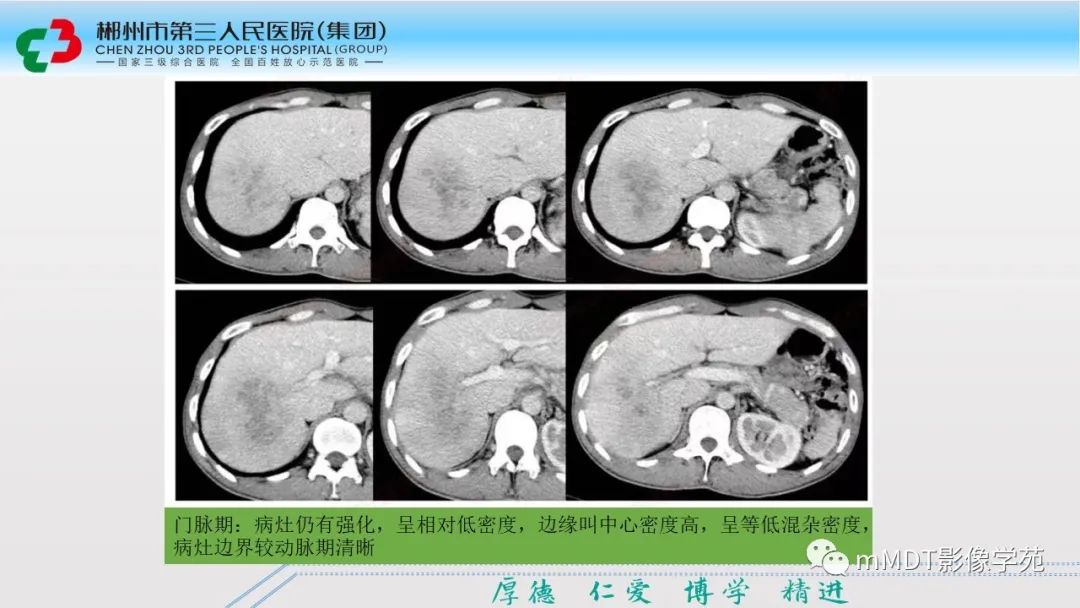 影像PPT - 【PPT】肝脏结核的CT诊断-26