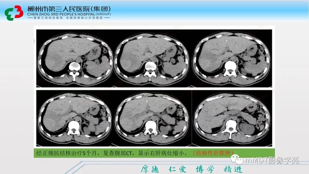 影像PPT - 【PPT】肝脏结核的CT诊断-28
