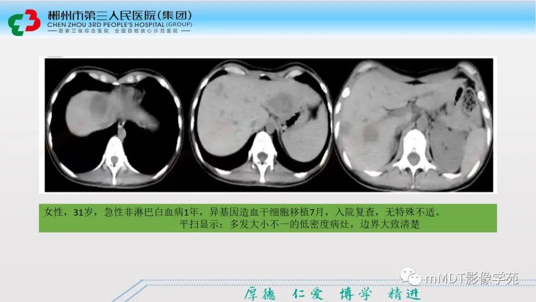 影像PPT - 【PPT】肝脏结核的CT诊断-30