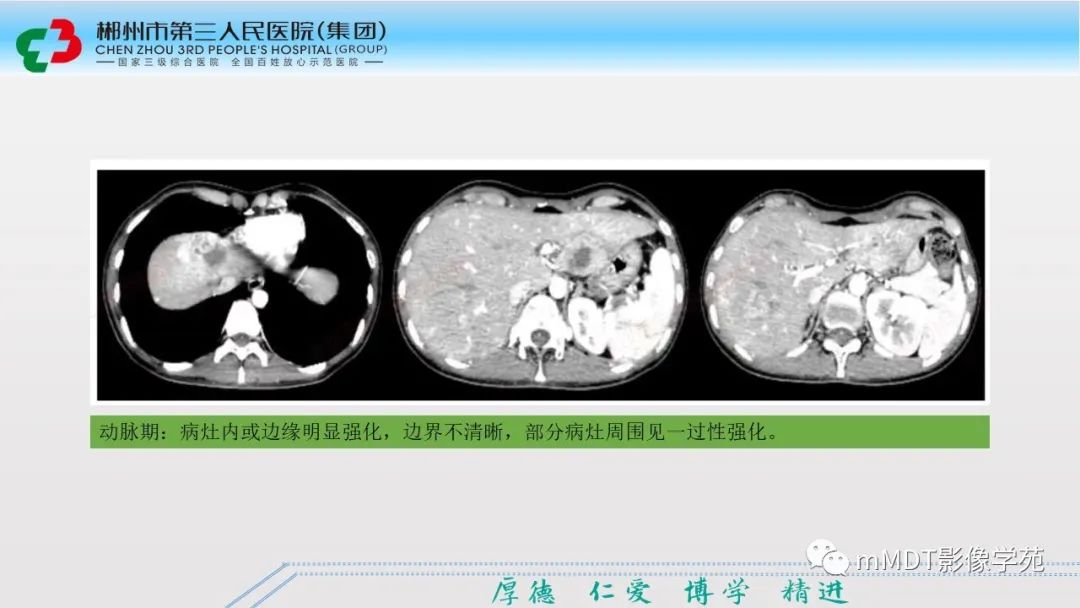 影像PPT - 【PPT】肝脏结核的CT诊断-31