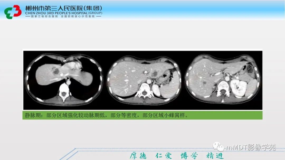 影像PPT - 【PPT】肝脏结核的CT诊断-32