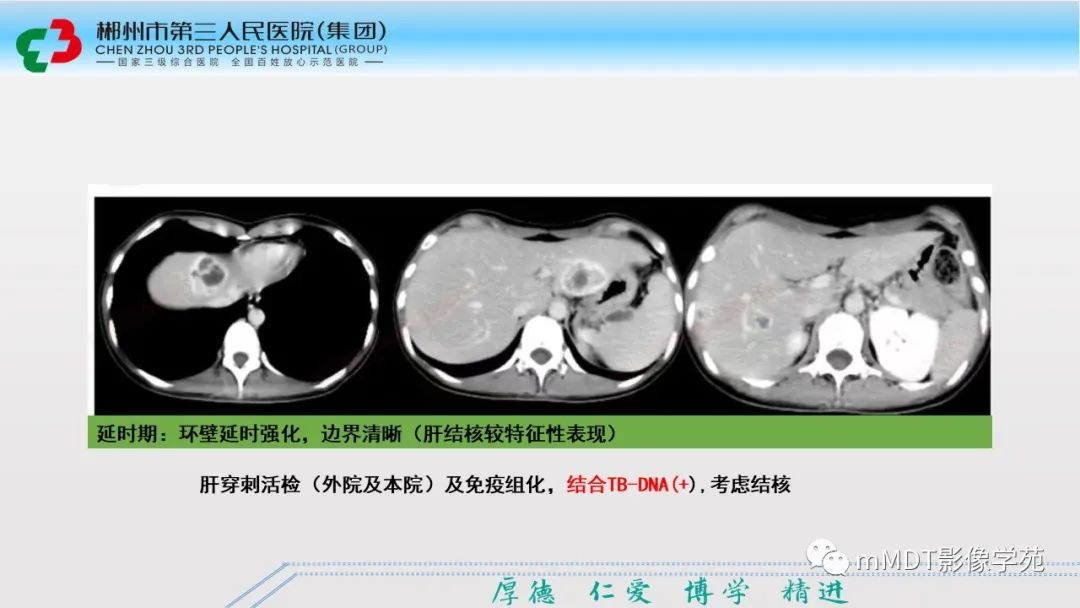 影像PPT - 【PPT】肝脏结核的CT诊断-33
