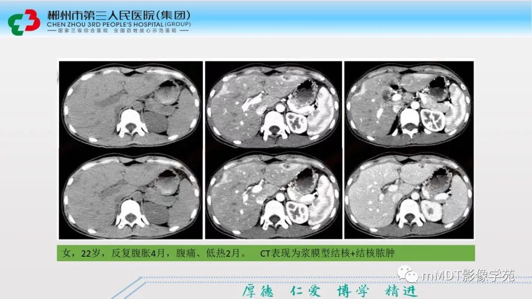 影像PPT - 【PPT】肝脏结核的CT诊断-36
