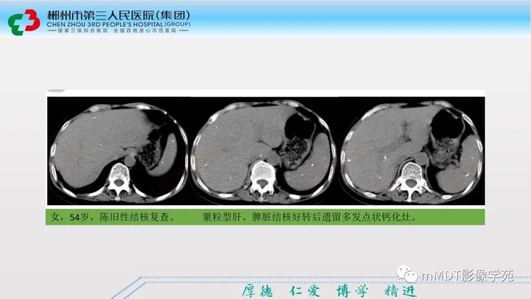 影像PPT - 【PPT】肝脏结核的CT诊断-37