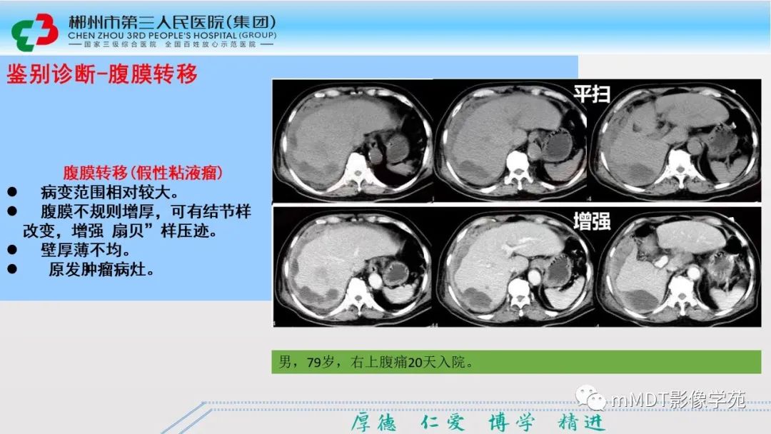 影像PPT - 【PPT】肝脏结核的CT诊断-39