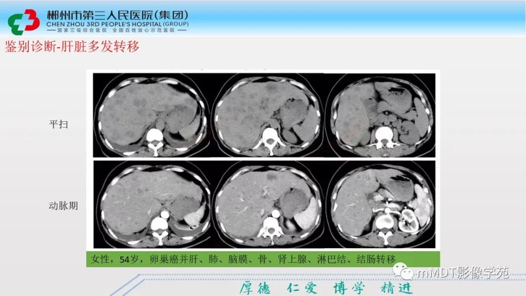 影像PPT - 【PPT】肝脏结核的CT诊断-40