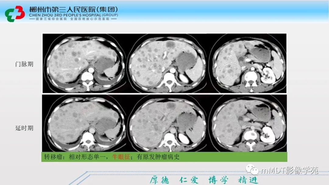 影像PPT - 【PPT】肝脏结核的CT诊断-41