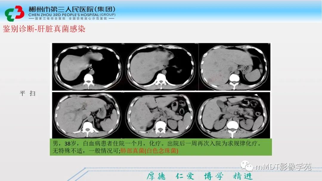 影像PPT - 【PPT】肝脏结核的CT诊断-42