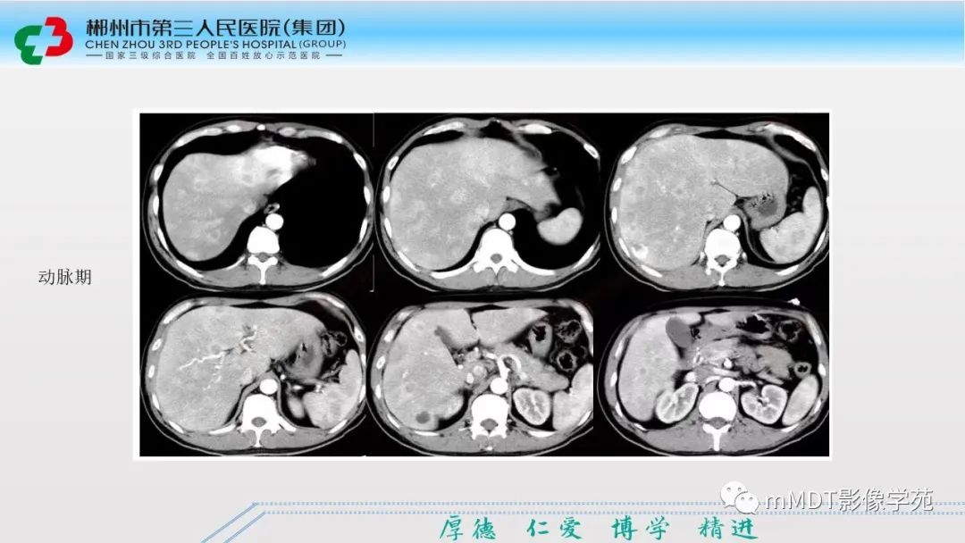 影像PPT - 【PPT】肝脏结核的CT诊断-43
