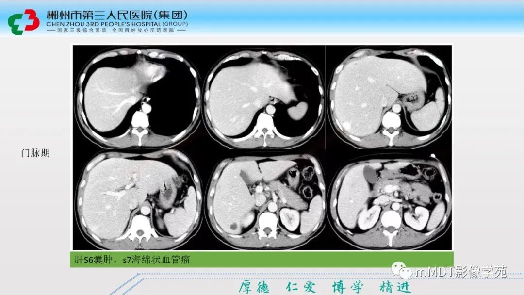 影像PPT - 【PPT】肝脏结核的CT诊断-44