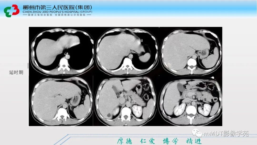 影像PPT - 【PPT】肝脏结核的CT诊断-45
