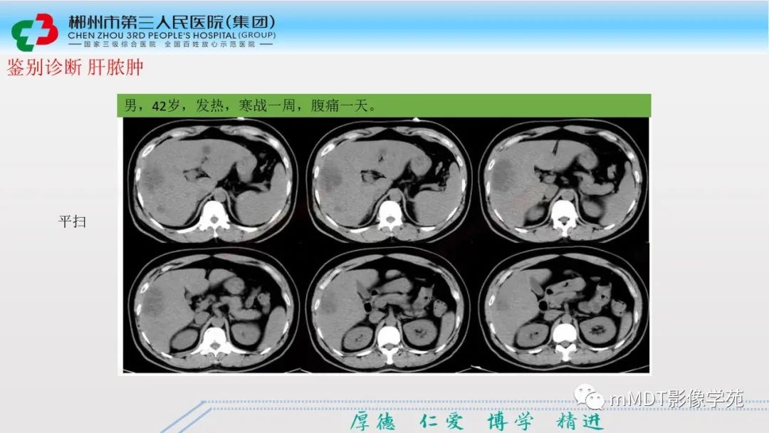 影像PPT - 【PPT】肝脏结核的CT诊断-47