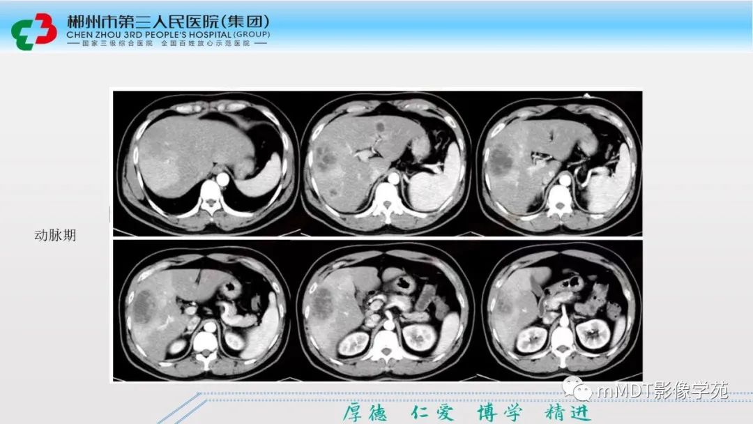 影像PPT - 【PPT】肝脏结核的CT诊断-48