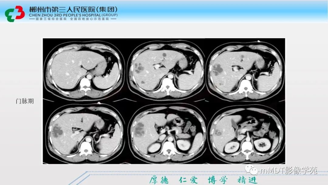 影像PPT - 【PPT】肝脏结核的CT诊断-49