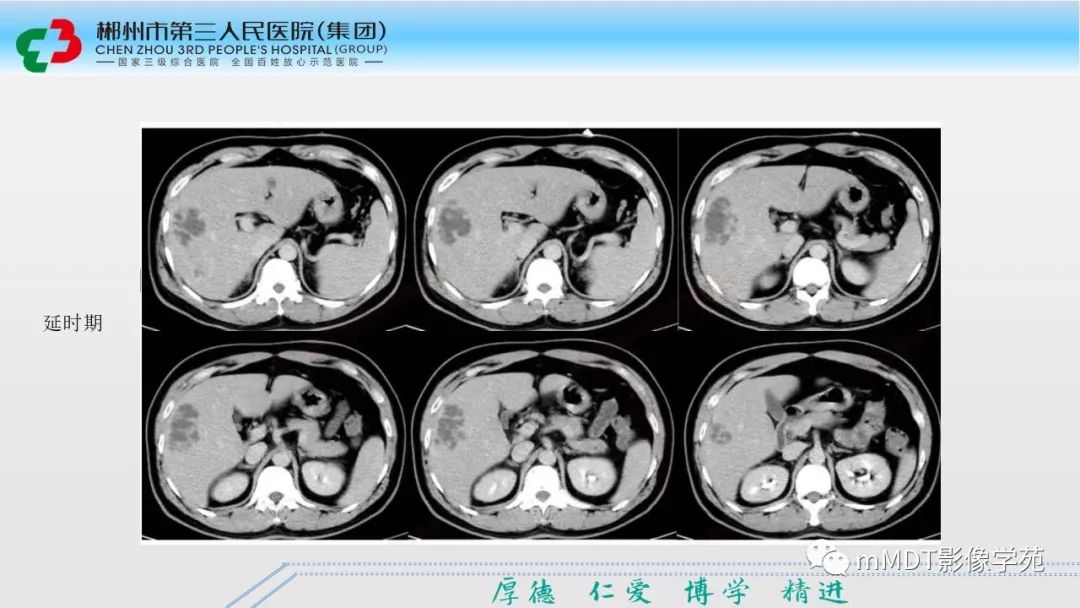 影像PPT - 【PPT】肝脏结核的CT诊断-50