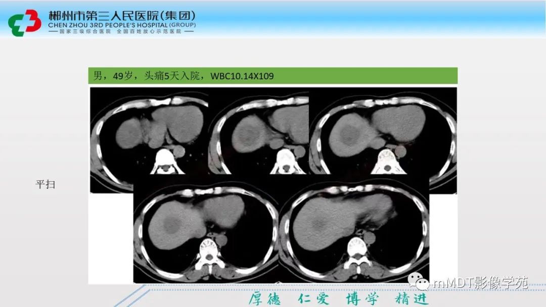 影像PPT - 【PPT】肝脏结核的CT诊断-52