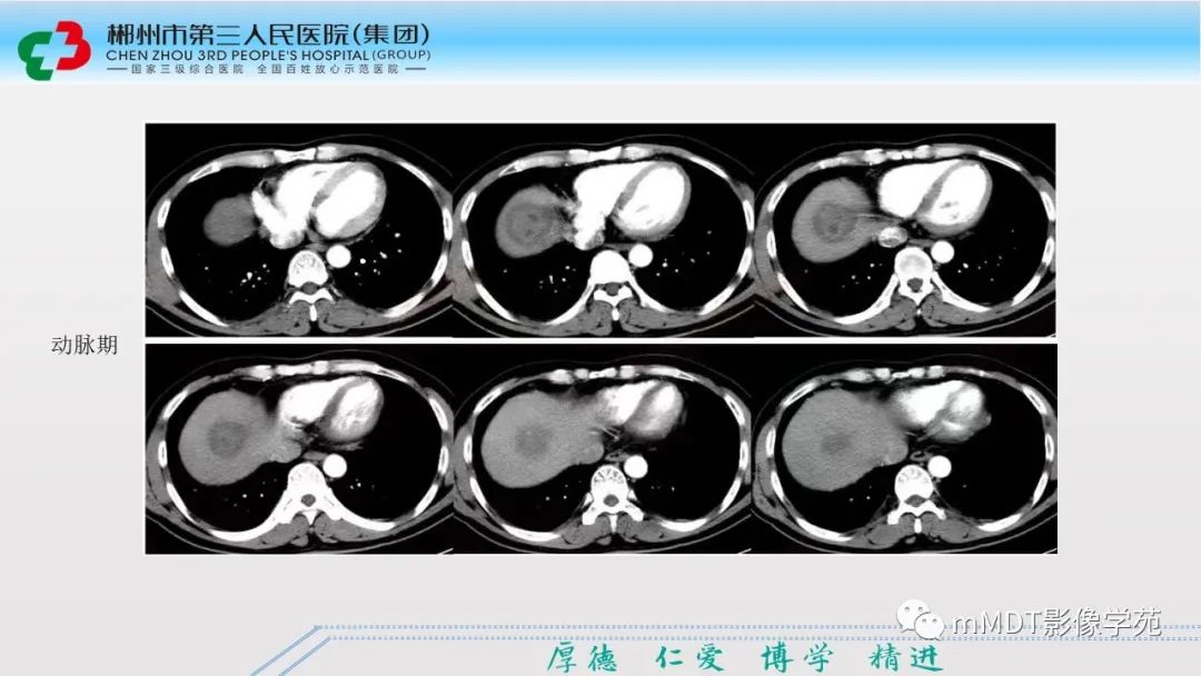 影像PPT - 【PPT】肝脏结核的CT诊断-53