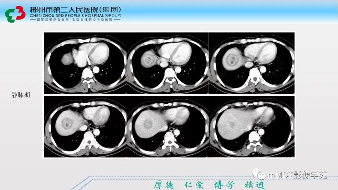 影像PPT - 【PPT】肝脏结核的CT诊断-54