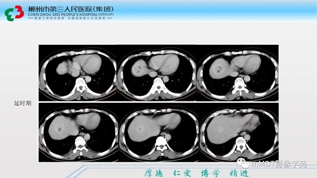 影像PPT - 【PPT】肝脏结核的CT诊断-55