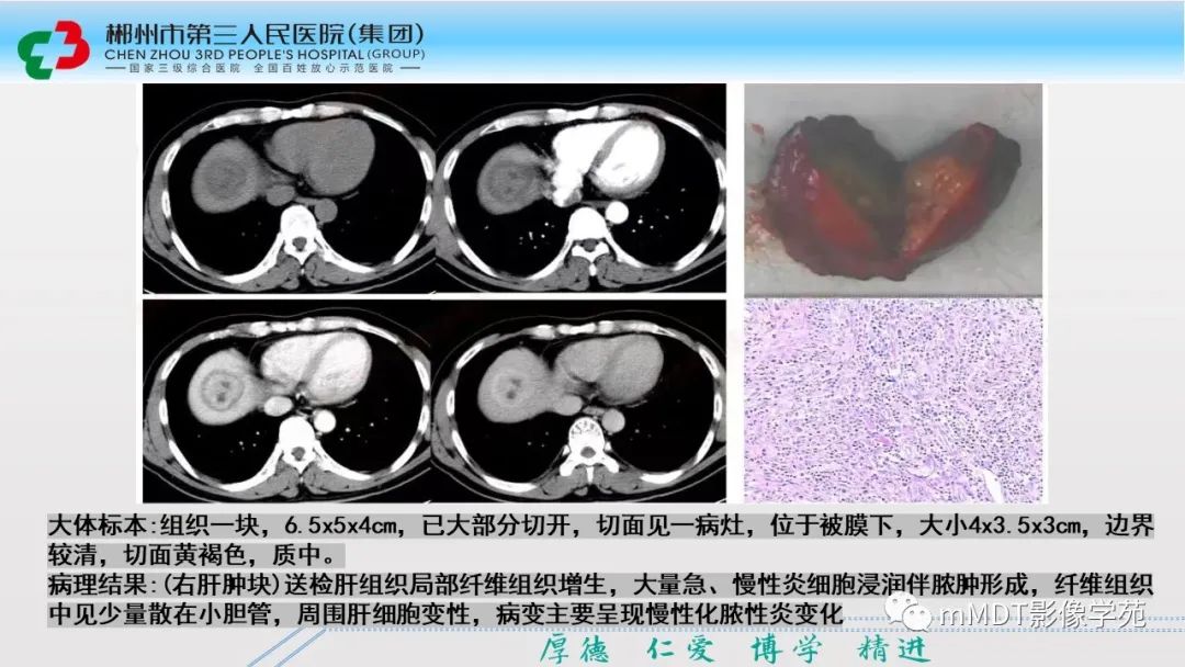 影像PPT - 【PPT】肝脏结核的CT诊断-56