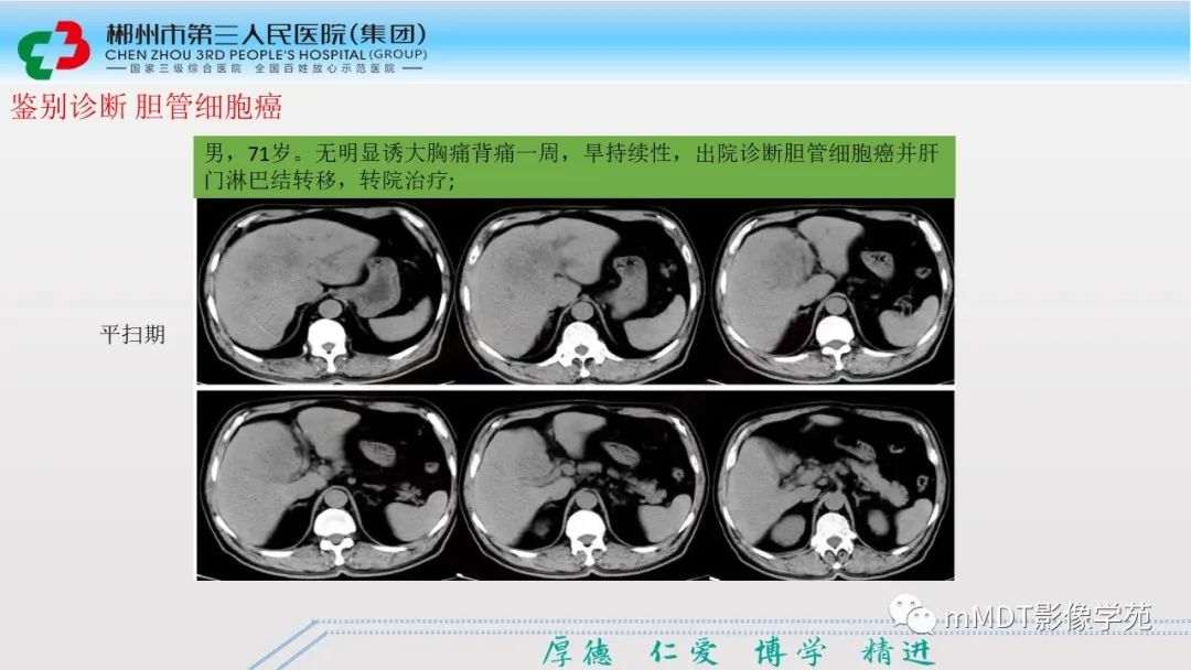 影像PPT - 【PPT】肝脏结核的CT诊断-58
