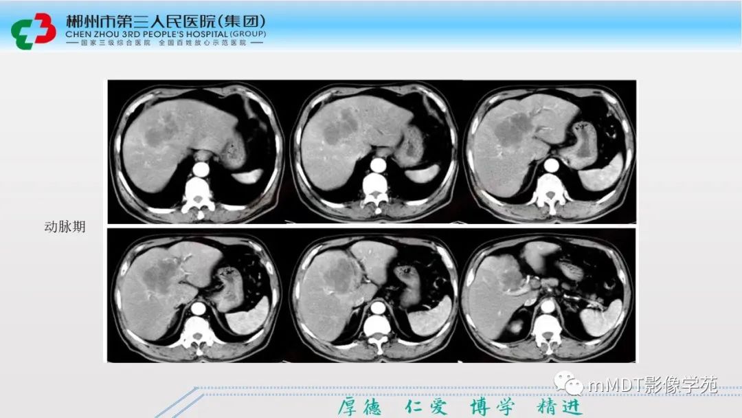 影像PPT - 【PPT】肝脏结核的CT诊断-59
