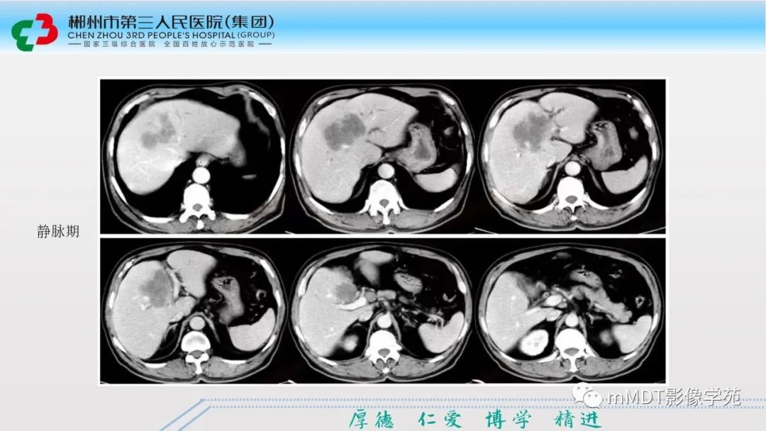 影像PPT - 【PPT】肝脏结核的CT诊断-60