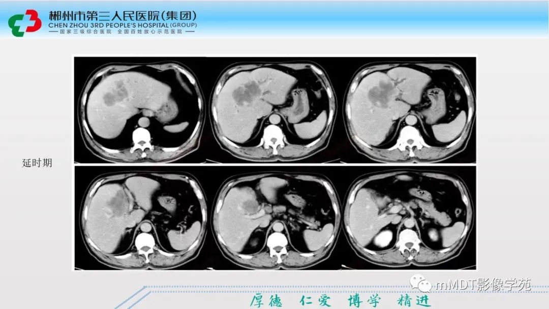 影像PPT - 【PPT】肝脏结核的CT诊断-61