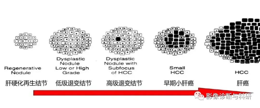 影像PPT - 肝硬化结节影像特征及如何判断是否癌变-1 影像PPT - 肝硬化结节影像特征及如何判断是否癌变-1