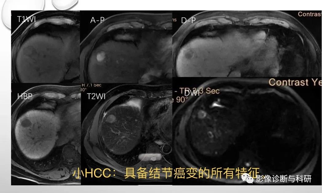 影像PPT - 肝硬化结节影像特征及如何判断是否癌变-8 影像PPT - 肝硬化结节影像特征及如何判断是否癌变-8