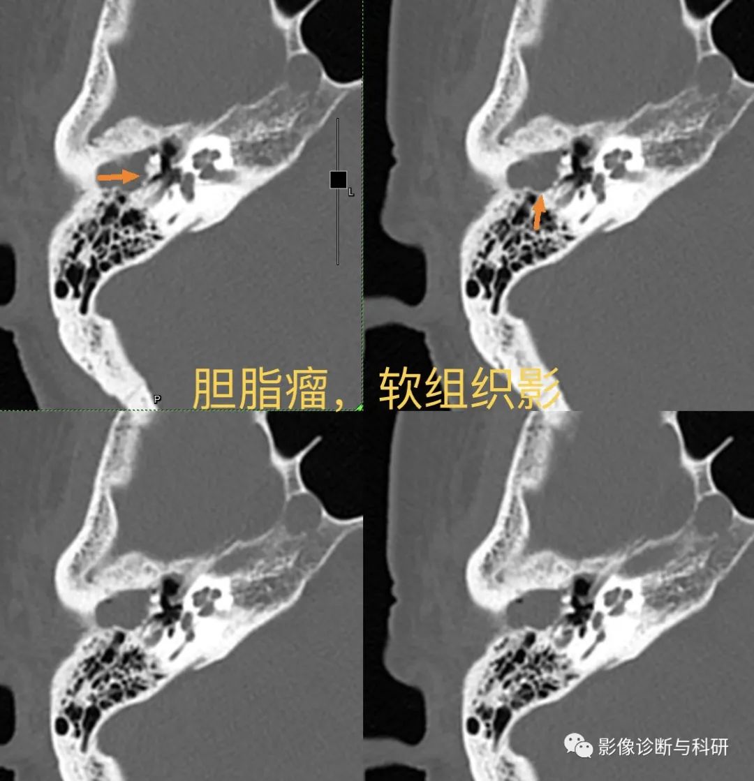 影像PPT - 乳突炎,如何判断是否伴胆脂瘤?-2 影像PPT - 乳突炎,如何判断是否伴胆脂瘤?-2