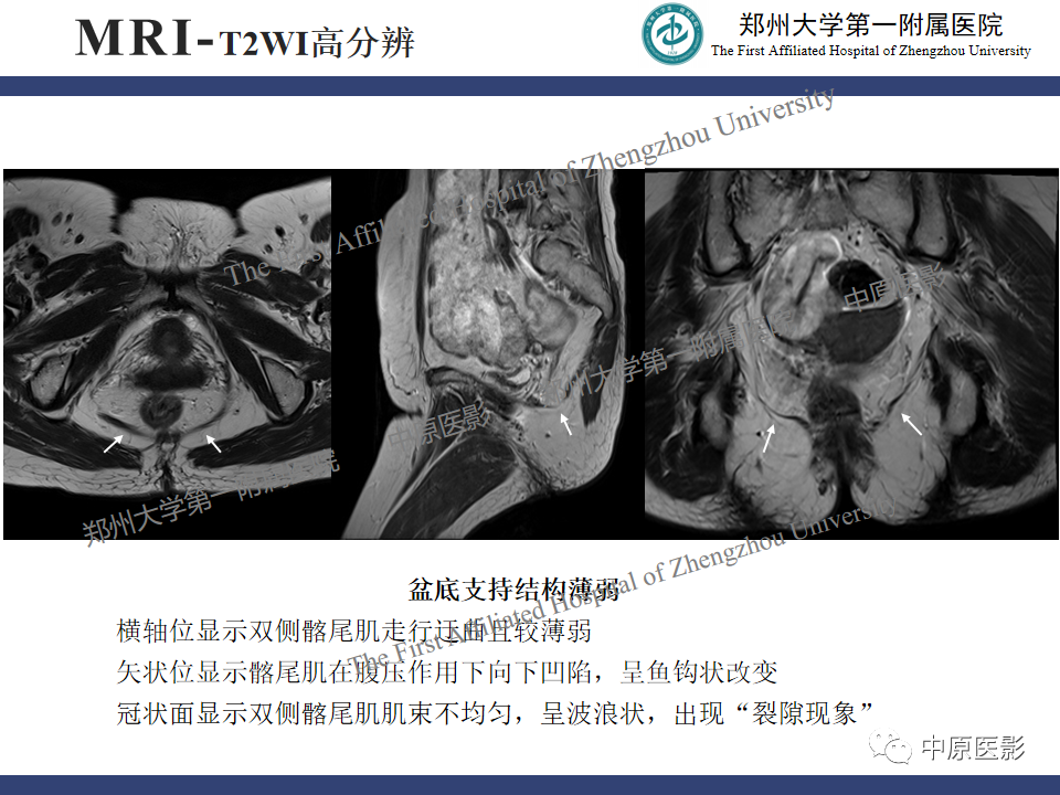 影像PPT - 【病例】盆底功能障碍性疾病2例MR影像-3