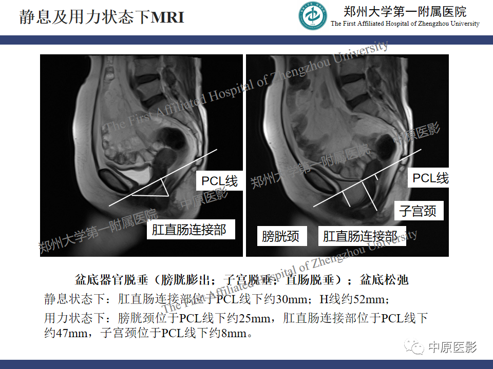 影像PPT - 【病例】盆底功能障碍性疾病2例MR影像-4