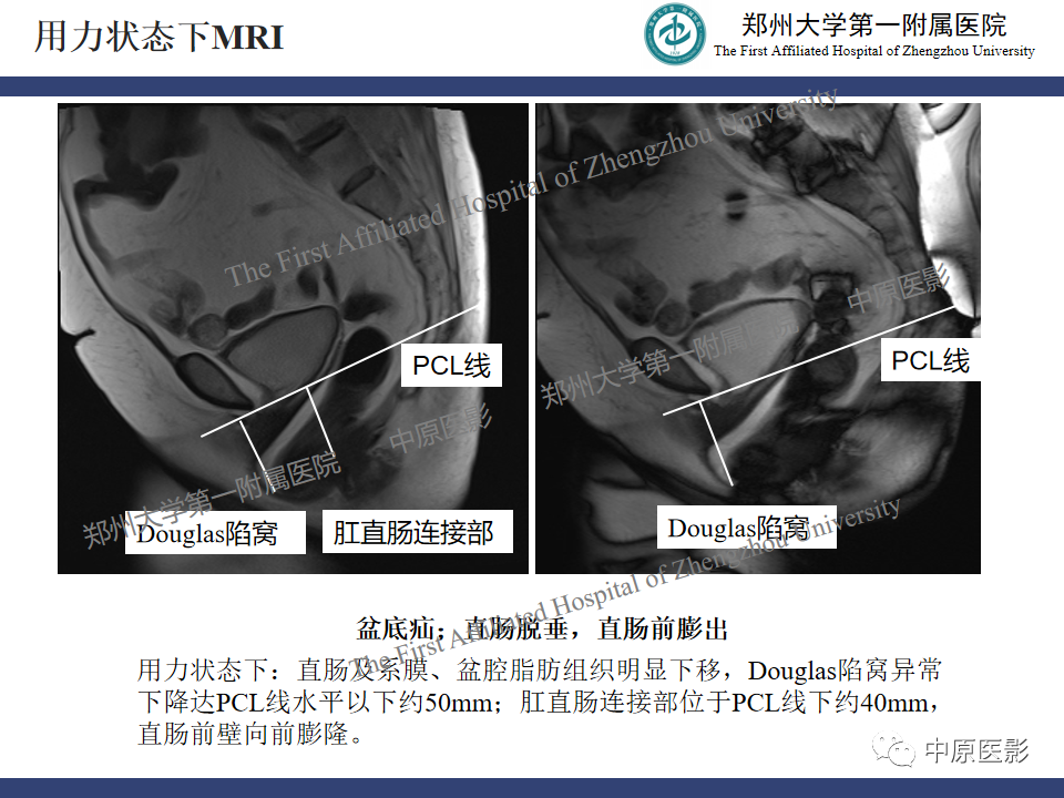 影像PPT - 【病例】盆底功能障碍性疾病2例MR影像-6